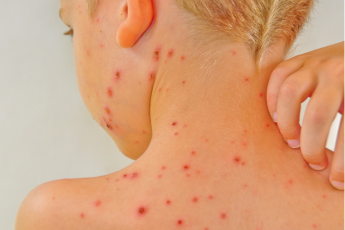 Sarampo cresce 32 vezes nas Américas em um ano; veja situação do Brasil